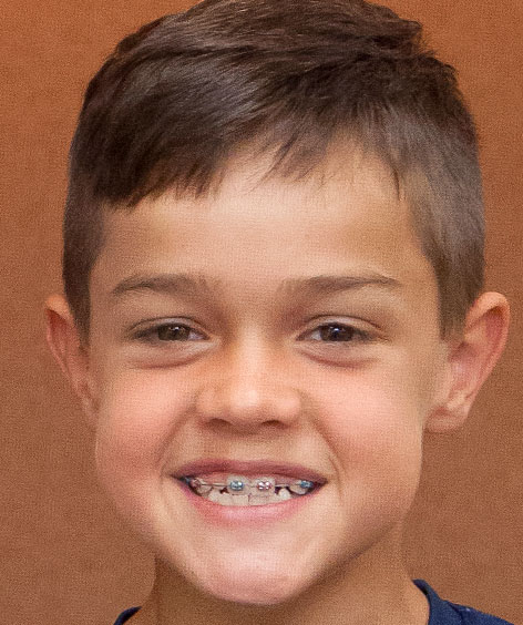 Orthodontics for Children - St. Charles, IL