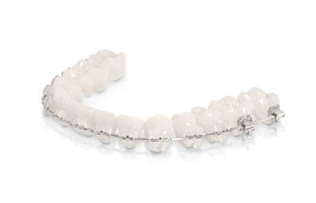 Teen Clarity Braces