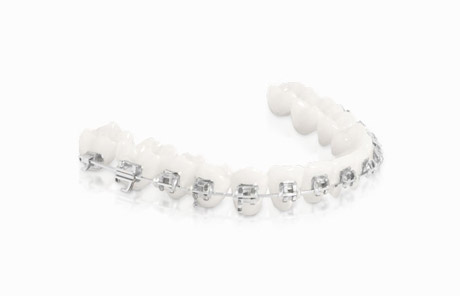 Victory Series Braces